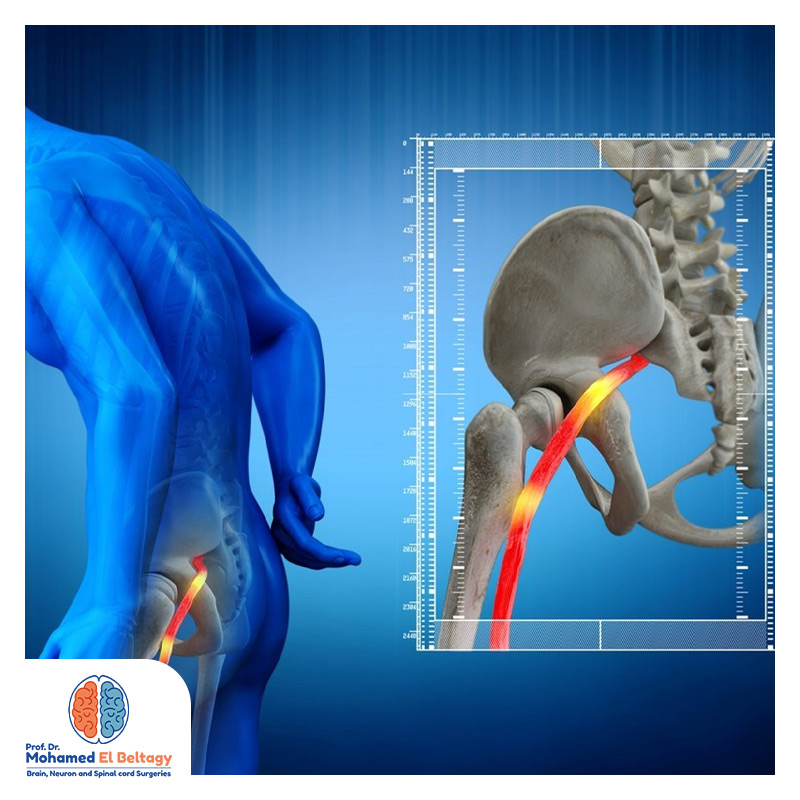 التدخل الجراحي لعلاج عرق النسا